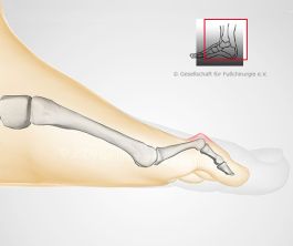bewegliche Hammerzehe