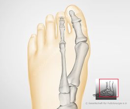 Hallux valgus: leichte Form