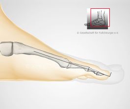 Hammerzeh-Op mit Versteifung und Draht