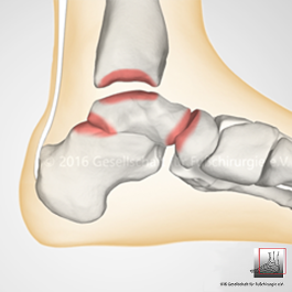 Arthrose im Sprunggelenk