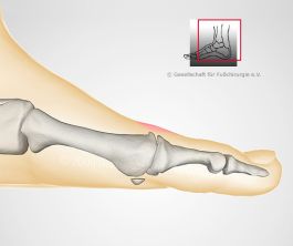 Verschleiß des Großzehengrundgelenkes (Arthrose)