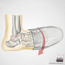 Sprunggelenksinstabilität