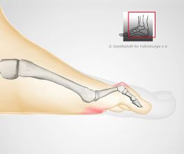 Hammerzeh-Op mit Versteifung des Mittelgelenkes