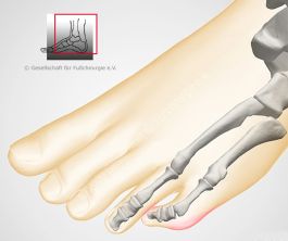 verkrümmte Kleinzehe