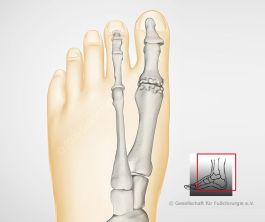 Verschleiß des Großzehengrundgelenkes (Arthrose)