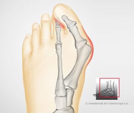 Hallux valgus: Schwere Form
