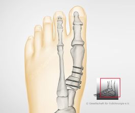Umstellungsoperation - schließende Methode