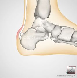 Dorsaler Fersenschmerz