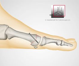 gelenkerhaltende Operation