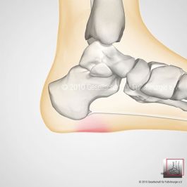 Plantarer Fersenschmerz