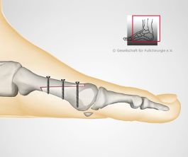 Operation nach Meyer/Scarf - seitlich