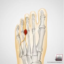 Morton Metatarsalgie