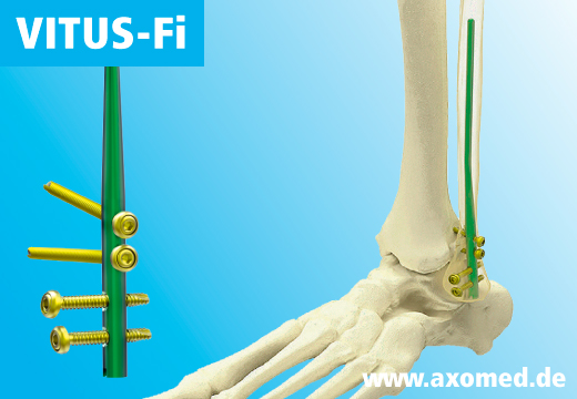 VITUS-Fi