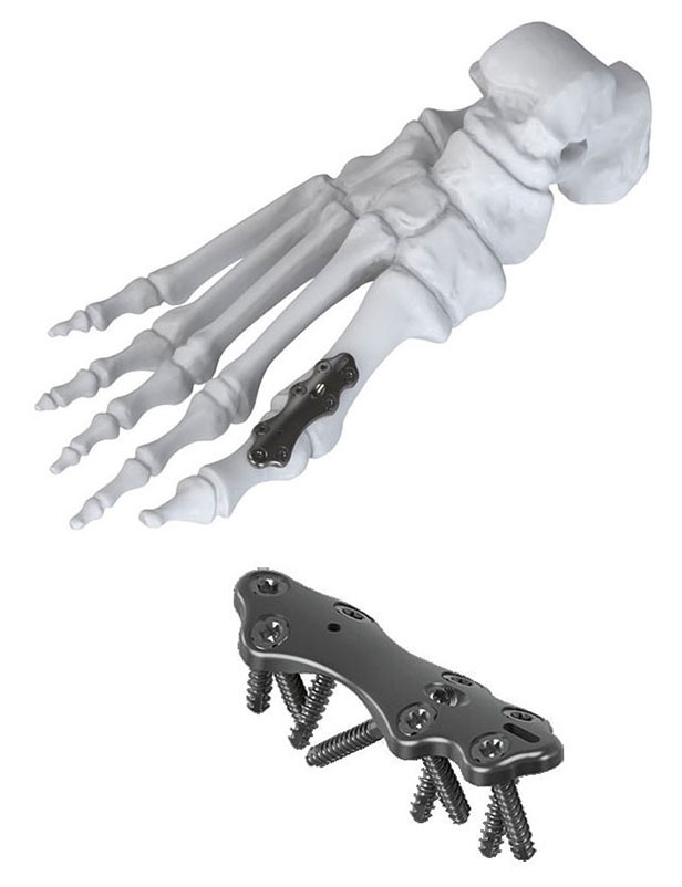 RIFIX  winkelstabile Titan-Platten