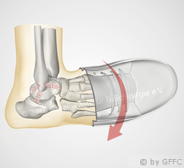 Sprunggelenksinstabilität