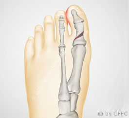 Hallux valgus interphalangeus