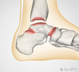 Arthrose im Sprunggelenk