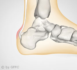 Dorsaler Fersenschmerz