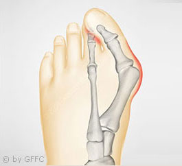 Hallux valgus