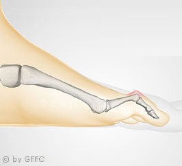 Kleinzehen­fehlstellung