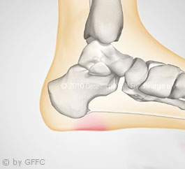 Plantarer Fersenschmerz